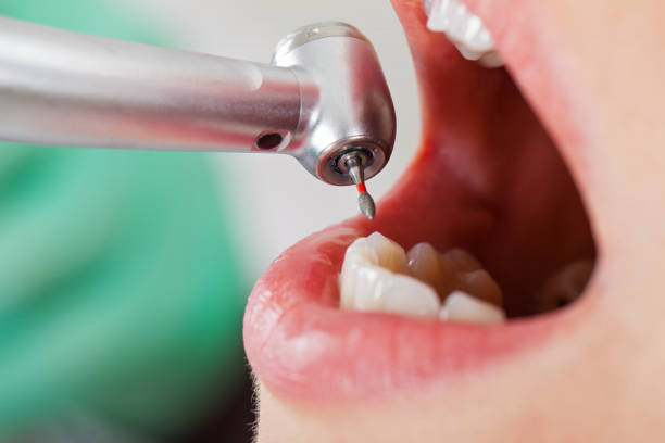 Best Emergency Dental Care for Abscessed Tooth in Farmville, VA